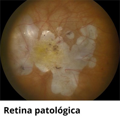 LA RETINA: LA VENTANA AL MUNDO QUE A VECES SE APAGA - Imagen 3